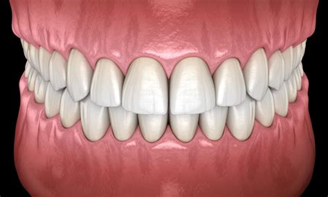 How Does My Bite Classification Impact My Orthodontic Treatment? - Love ...