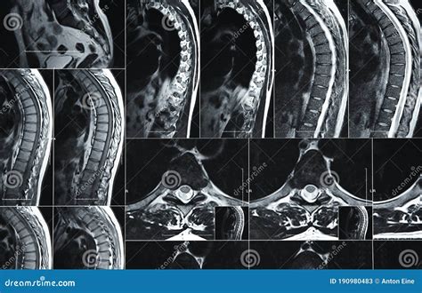 MRI Or CT Scan Of Human Lumbar Spine Royalty-Free Stock Photo ...