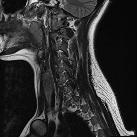 Normal trauma cervical spine MRI | Radiology Case | Radiopaedia.org