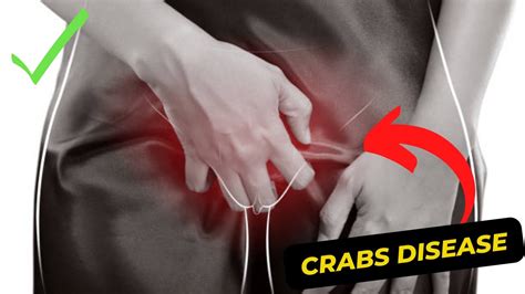 Understanding Crabs Disease: Symptoms, Causes and Treatment - YouTube