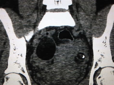 Teratoma - International Collaboration Studies Teratoma with Malignant ...