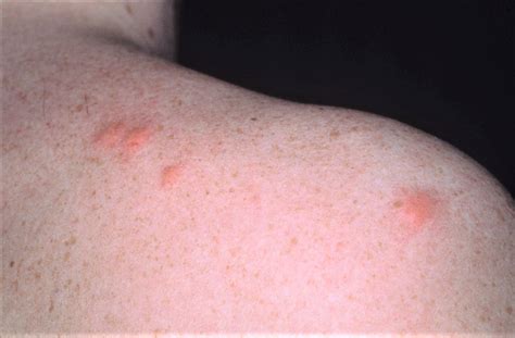 Mosquito Bites - Allergy & Treatment - How to Get Rid of Mosquito Bites