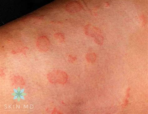 Fungal Skin Rash Pictures | Mama Natural