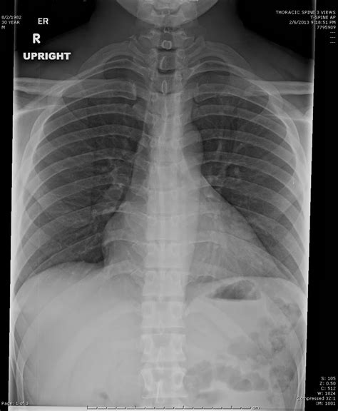 Dr Rob Sports Orthopedic Rehabilitation: Thoracic spine radiograph