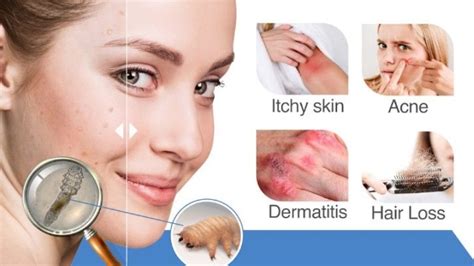 Understanding Demodex Mites Role in Common Skin Woes - OZIDEX