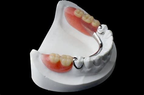 Partial Dentures – Philp Family Dentistry – Waconia Dentist