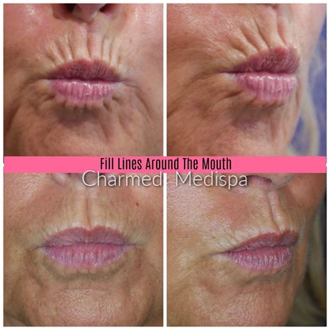 Lip Lines And Creases Around The Mouth Quick Fix – Charmed Medispa