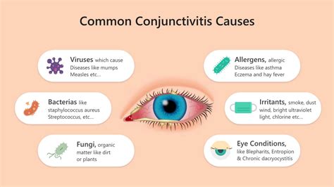 What Is Bacterial Conjunctivitis Symptoms Causes Treatment | Hot Sex ...