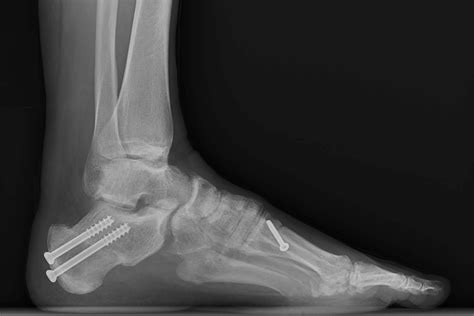 High Arch Foot — Daniel Bohl, MD | Midwest Orthopaedics at RUSH