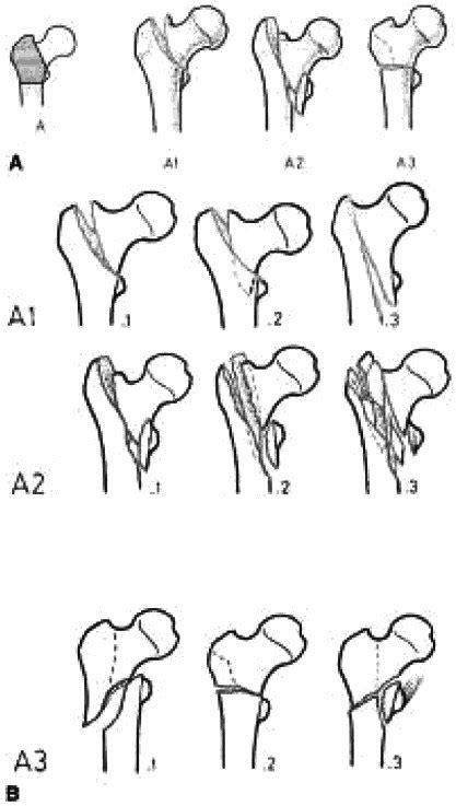 Ao Classification Femur Fracture