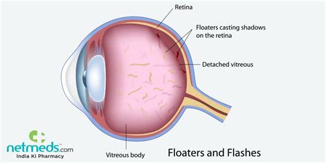 Eye Floaters: Causes, Symptoms And Treatment