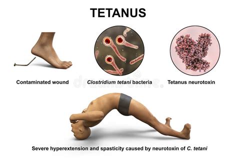 Tetanus Disease, Opisthotonus in a Man Suffering from Tetanus Stock ...