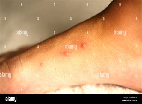 Bed bug bites hi-res stock photography and images - Alamy