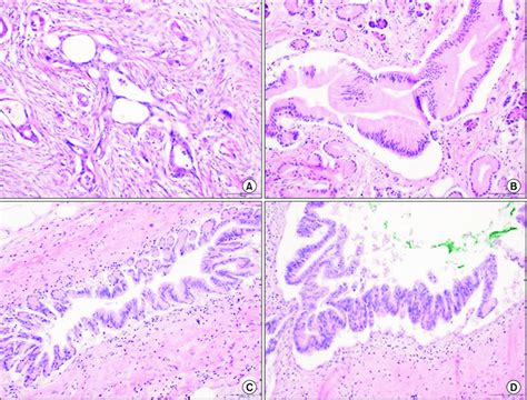 Histological features of pancreatic adenocarcinoma and pancreatic ...