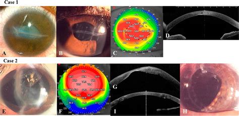 Representative case of corneal perforation. Figure 1 shows typical ...