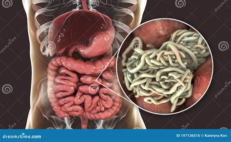 Parasitic Worms in Human Intestine Stock Illustration - Illustration of ...