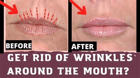 How to Get Rid of Wrinkles around the Mouth ?|Mouth Lines| upper lip ...