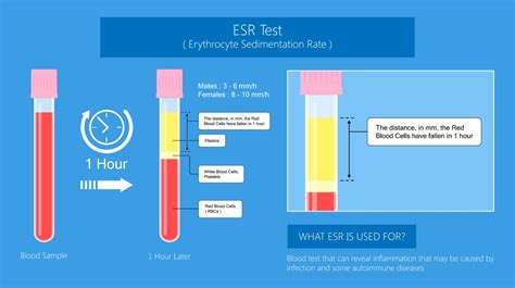 What is the erythrocyte sedimentation rate (ESR)? • The Blood Project