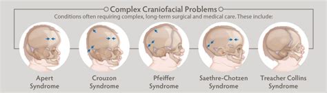 Craniofacial Anomalies | Craniofacial Conditions & Surgeries - AAOMS ...