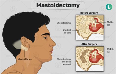 Mastoidectomy: Procedure, Purpose, Results, Cost, Price