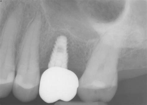 Dental Implant Failure after 8 months: Your Thoughts?