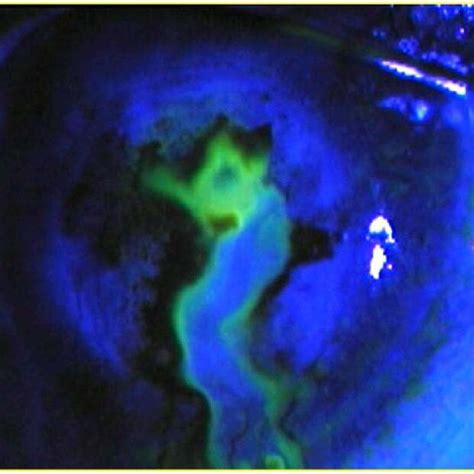 Shows successful healing in moderate corneal perforation using scleral ...