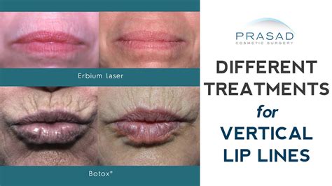 What’s the Best Treatment for Wrinkles Above Lips? | Dr. Prasad Blog