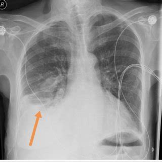 CT of the thorax showing bilateral empyema (see arrows) | Download ...