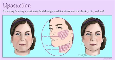 Facial fat – What kind of corrective procedure or surgery is right for ...