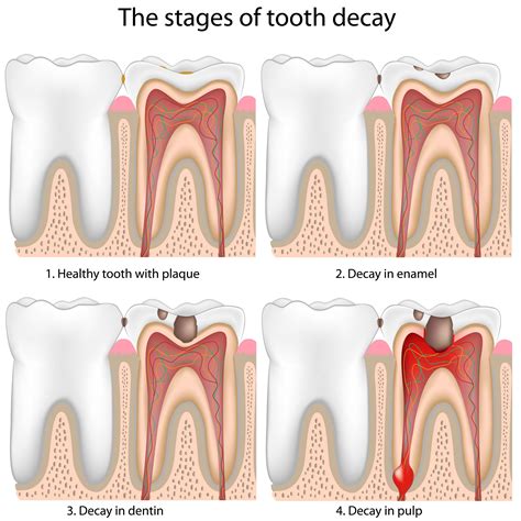 Stages of Tooth Decay - Wichita, KS Treating Cavities