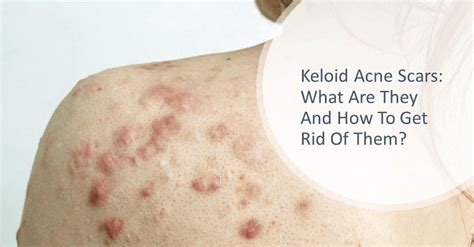 Keloid Acne Scars: What Are They And How To Get Rid of Them? | Dream ...