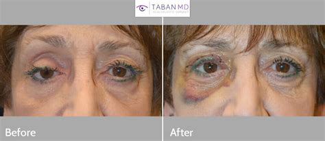 Prosthetic Eye & Socket Surgery Before and After Photos | Taban MD