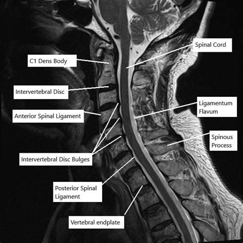 Mri Cervical Spine Lumbar Spine Mri Scan Images Spinal Stenosis ...