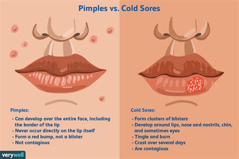 Is It a Cold Sore or Pimple?