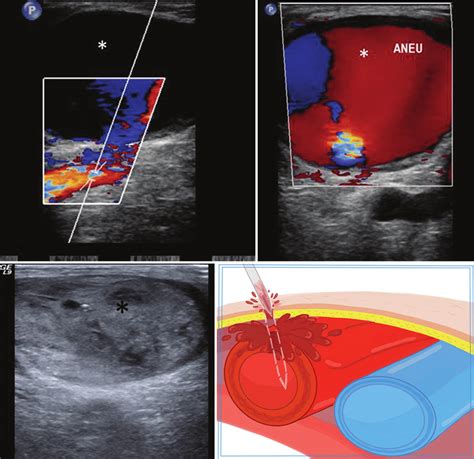 Femoral Artery Ultrasound