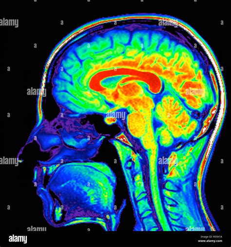 Farbige Magnetresonanztomographie (MRT) Scan eines Sagittalschnitt ...