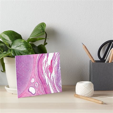 "Teratoma Histology" Art Board Print for Sale by deltoid | Redbubble