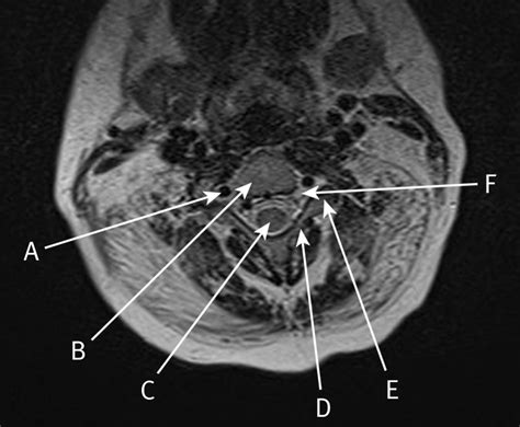 Mri Spine Anatomy Free Mri Axial Cervical Spine Anatomy Anatomy ...