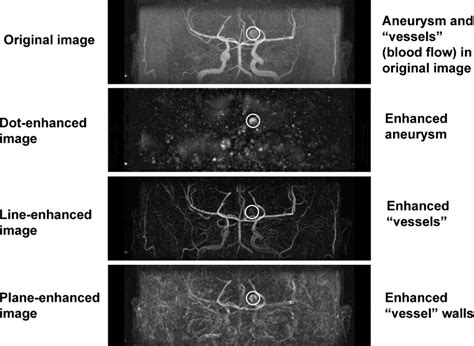 Illustration of an original magnetic resonance angiography (MRA) image ...