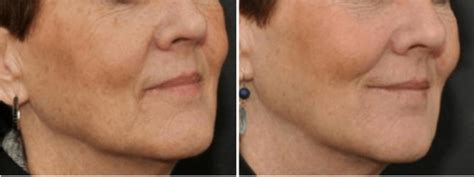 How Can I Reduce the Appearance of Wrinkles Around My Mouth? | Boston ...