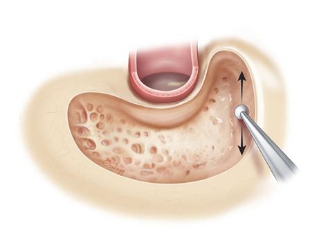 Intact Canal Wall Mastoidectomy – Oto Surgery Atlas