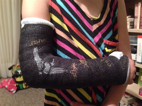 Black cast + silver sharpie = Broken arm X-ray cast! | Broken arm ...