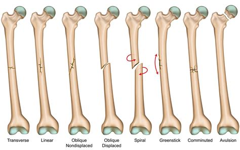 Hip Fracture