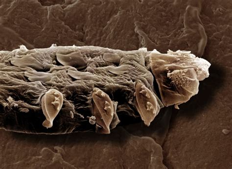 Demodex Folliculorum Mites