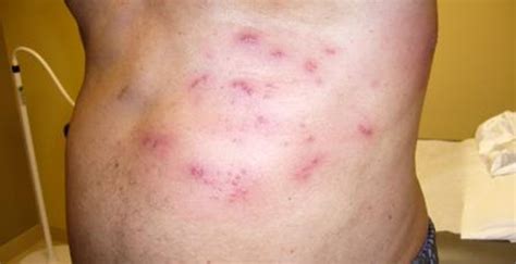 Type 2 diabetic male experiencing painful rash - Journal of Urgent Care ...