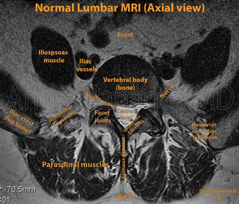 Labeled Axial Mri Lumbar Spine