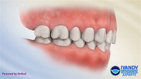 Perfect Bite Teeth Alignment Side View - TeethWalls