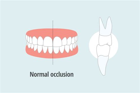 Overbite vs Normal Bite: Differences, Causes, and Treatment