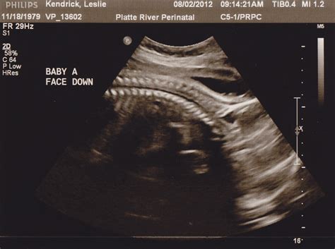 Two Babies, 280 Days, One Womb: 31 Week Ultrasound