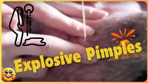 🌟😲 Epic Pimple Popping Extravaganza: Unbelievable Squeezes! 😲🌟 - YouTube